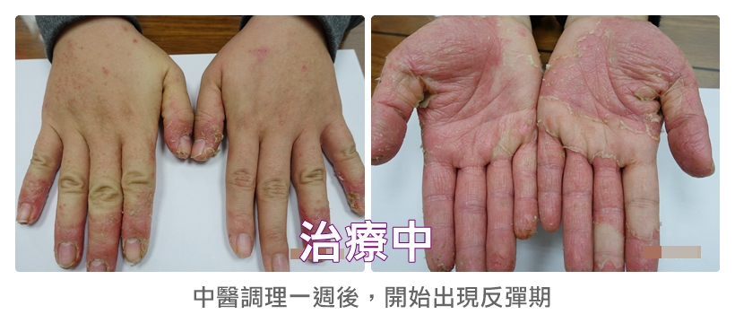 餐廳服務生3個月成功治癒雙手汗皰疹3